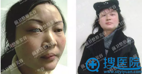 先天性唇裂畸形、鼻翼塌陷救助案例 先天性唇裂畸形、鼻翼塌陷救助案例