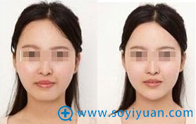 成都美容整形医院丰下巴前后对比照 成都美容整形医院丰下巴前后对比照