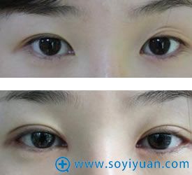 韩国BIO曹仁昌双眼皮过浅修复案例 韩国BIO曹仁昌双眼皮过浅修复案例