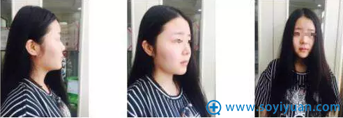 硅胶+自体耳软骨隆鼻整形前后对比 他们说我有迪丽热巴的感觉