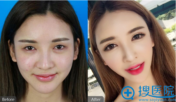 成都美容整形医院<!--<i data=20240710 data-id=16577></i>-->主任美眼案例前后对比 成都美容整形医院<!--<i data=20240710 data-id=16577></i>-->主任美眼案例前后对比