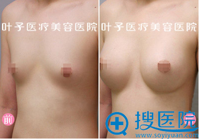 武汉叶子无痕美胸术后对比照 武汉叶子无痕美胸术后对比照
