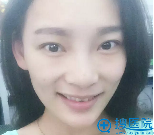 双眼皮术后7天素颜照 双眼皮术后7天素颜照