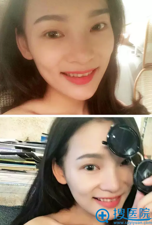 双眼皮7天了,化了个妆 双眼皮7天了,化了个妆