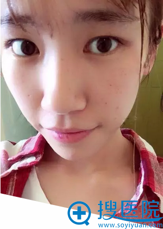 【真实经历】在福州名韩整形医院花4980元找李阳割双眼皮40天了