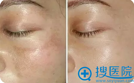 皮秒真人祛斑案例 皮秒真人祛斑案例
