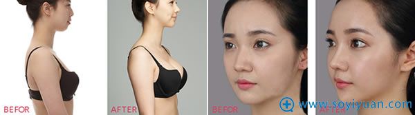 江苏施尔美隆胸隆鼻案例效果图 江苏施尔美隆胸隆鼻案例效果图