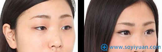 江苏施尔美双眼皮前后对比照片 江苏施尔美双眼皮前后对比照片