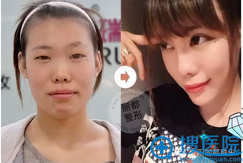 较后给大家看一张术前术后对比照,你还等什么 较后给大家看一张术前术后对比照,你还等什么