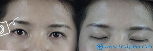 在<!--<i data=20240710 data-id=9793></i>-->做双眼皮之前照片 在<!--<i data=20240710 data-id=9793></i>-->做双眼皮之前照片