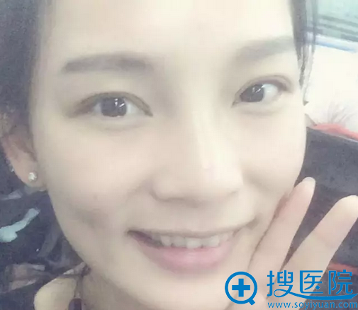 双眼皮4天效果 双眼皮4天效果
