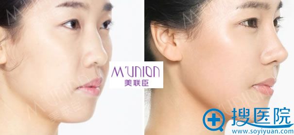 <!--<i data=20240710 data-id=14095></i>-->隆鼻案例效果图 <!--<i data=20240710 data-id=14095></i>-->隆鼻案例效果图