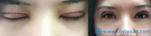 双眼皮术后第二天照片 双眼皮术后第二天照片
