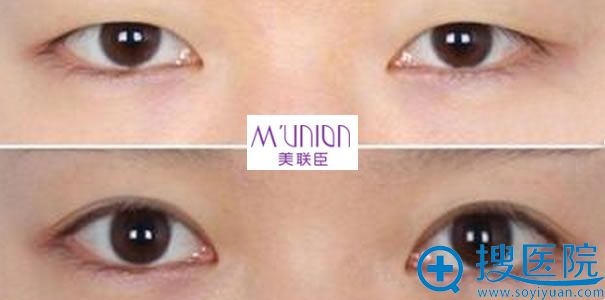 <!--<i data=20240710 data-id=14095></i>-->双眼皮案例效果图 <!--<i data=20240710 data-id=14095></i>-->双眼皮案例效果图