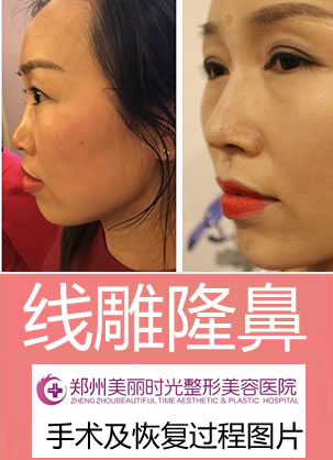 分享我在郑州美丽时光找郭晓光院长做线雕隆鼻恢复过程图片