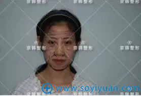京韩乔爱军院长面雕术前画线 京韩乔爱军院长面雕术前画线