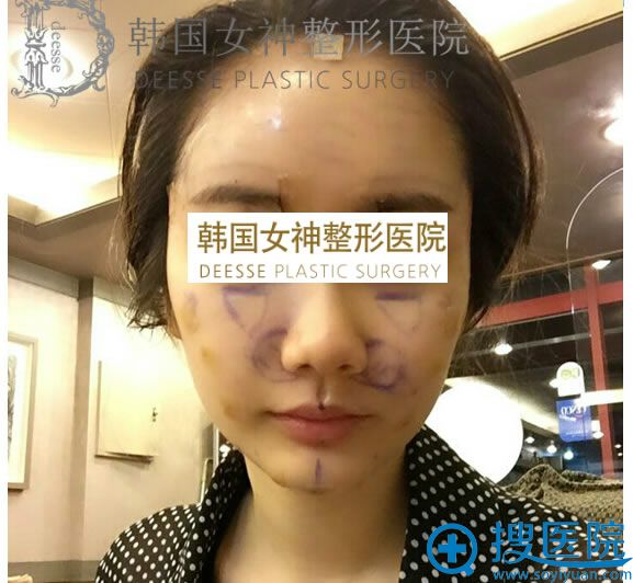 在韩国女神做的面部填充部位设计图 在韩国女神做的面部填充部位设计图