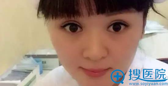 割双眼皮手术后10天的照片 割双眼皮手术后10天的照片