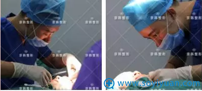 生物焊接双眼皮手术中 生物焊接双眼皮手术中