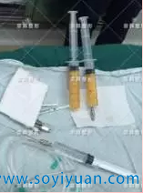 乔爱军院长刚吸出来待填充的自体脂肪 乔爱军院长刚吸出来待填充的自体脂肪