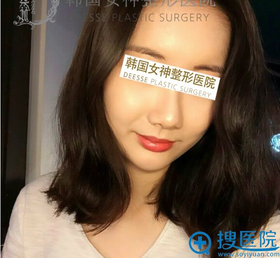 自体脂肪面部填充术后第15天照片 自体脂肪面部填充术后第15天照片