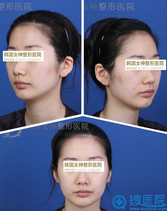 在韩国做自体脂肪面部填充前的照片 在韩国做自体脂肪面部填充前的照片