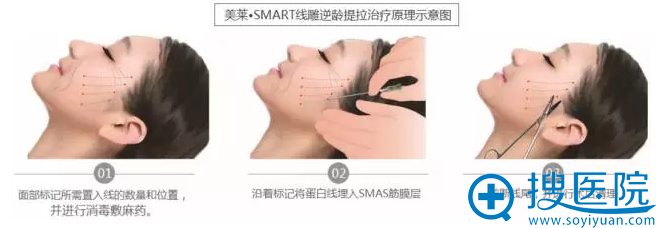 【真实经历】上海美莱整形主任申涛亲身体验PPDO线雕蛋白线提拉