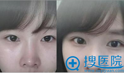 �������뿪�۽�ǰ��Ա�ͼ