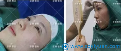 双眼皮手术即刻效果 双眼皮手术即刻效果