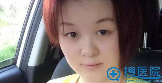 割双眼皮之前的照片 割双眼皮之前的照片