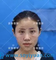 面雕+脂肪填充术后第二天效果 面雕+脂肪填充术后第二天效果
