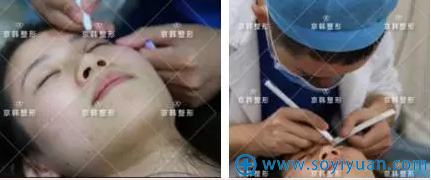 双眼皮画线 双眼皮画线