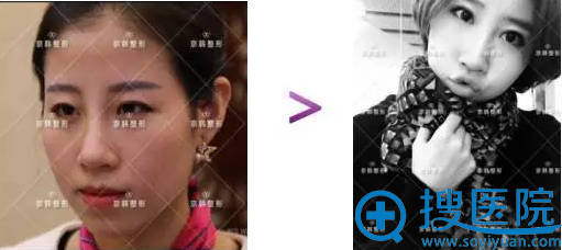 【真人案例】在北京京韩整形医院找乔爱军做脂肪填充+面雕6个月