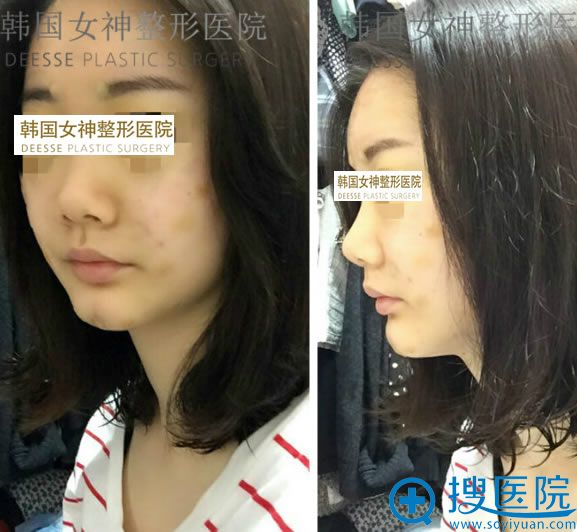 做面部脂肪填充手术后第五天照片 做面部脂肪填充手术后第五天照片