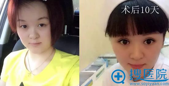 宁波尚丽整形割双眼皮前后效果对比照片 宁波尚丽整形割双眼皮前后效果对比照片