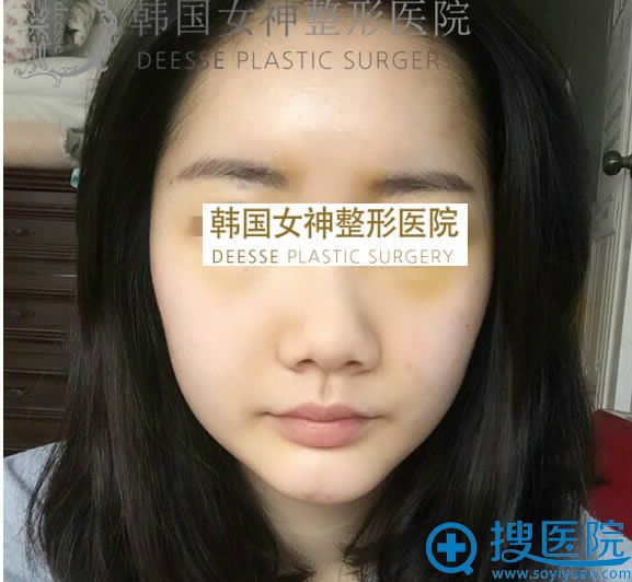 自体脂肪面部填充术后第六天照片 自体脂肪面部填充术后第六天照片