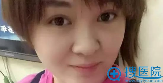 在尚丽整形割双眼皮术后三个月照片 在尚丽整形割双眼皮术后三个月照片
