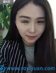 第9天恢复期照片 第9天恢复期照片