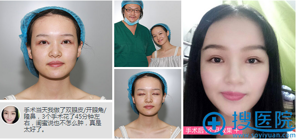 <!--<i data=20240710 data-id=13979></i>-->整容医院孟晨曦双眼皮、开眼角、隆鼻手术效果 <!--<i data=20240710 data-id=13979></i>-->整容医院孟晨曦双眼皮、开眼角、隆鼻手术效果