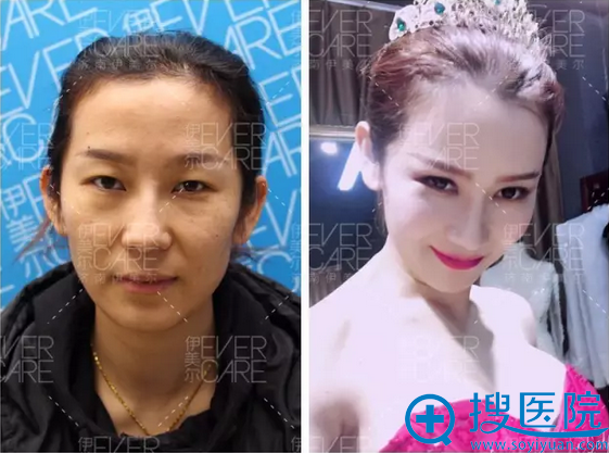 面诊了济南瑞丽和伊美尔后找王清峰做了双眼皮隆胸和脂肪填充