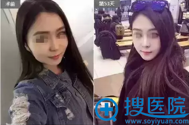 术前术后效果对比照 术前术后效果对比照