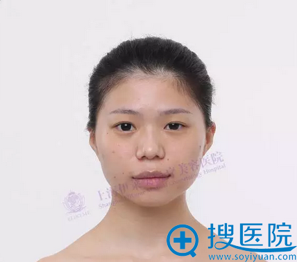 术前素颜照 术前素颜照