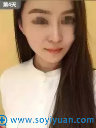 第4天恢复期照片 第4天恢复期照片
