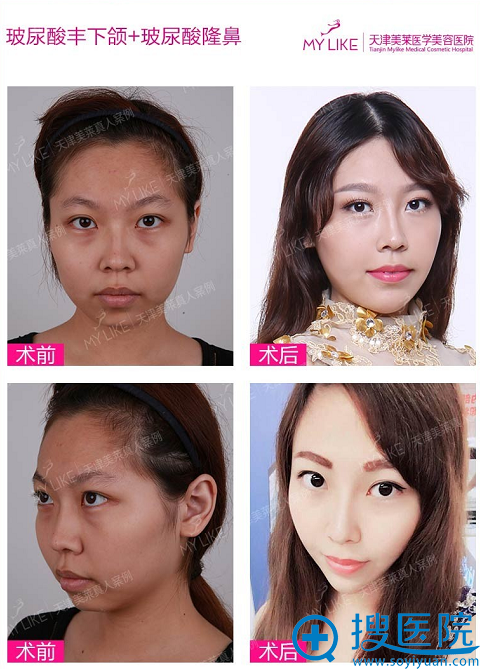 玻尿酸隆下颌、玻尿酸隆鼻前后对比图 玻尿酸隆下颌、玻尿酸隆鼻前后对比图