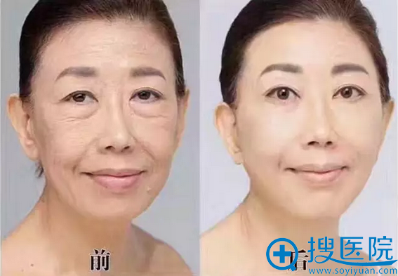 艾莉薇玻尿酸抗衰案例 艾莉薇玻尿酸抗衰案例