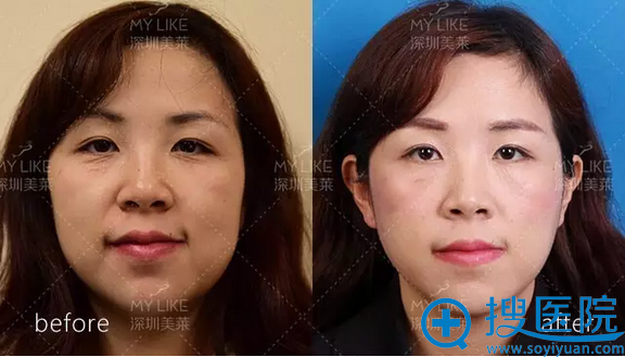 手术前后对比照 手术前后对比照