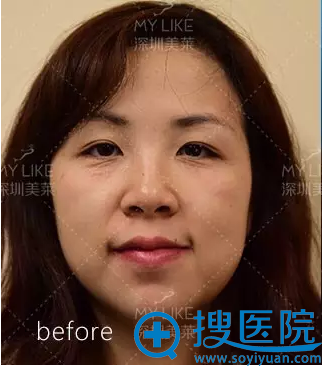 【真实经历】深圳美莱整形医院梁宇辉做1次线雕让我年轻了10岁