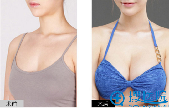 <!--<i data=20240710 data-id=8304></i>-->整形医院丰胸案例 <!--<i data=20240710 data-id=8304></i>-->整形医院丰胸案例