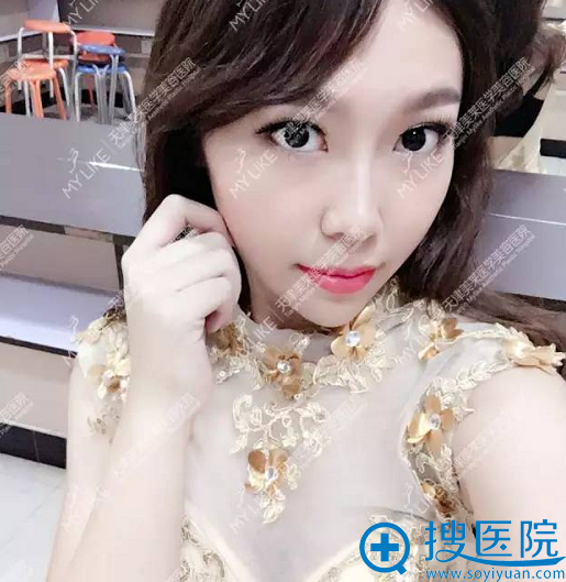 美莱玻尿酸隆下巴术后生活照 美莱玻尿酸隆下巴术后生活照