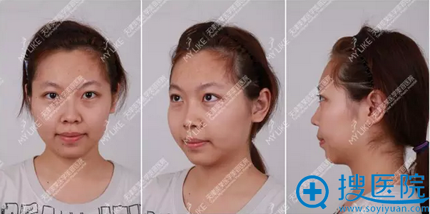 【亲身经历】在天津美莱整形医院注射玻尿酸隆下颌+隆鼻效果图